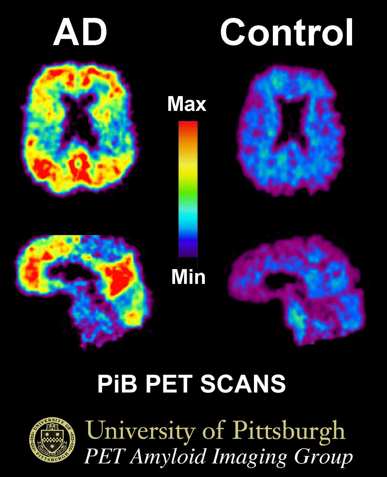 Image result for amyloid pet alzheimer's disease